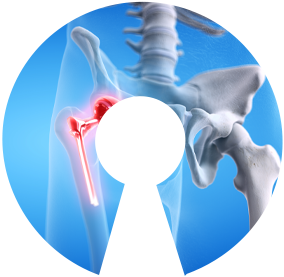 Matortho Casestudy Image Hip